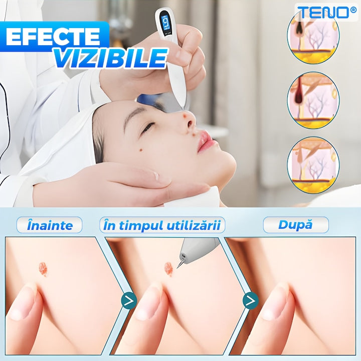 Stilou cu Plasma Teno®, pentru indepartarea alunitelor, petelor pigmentare, accesorii incluse, eficienta ridicata, autonomie mare, afisaj digital, alb