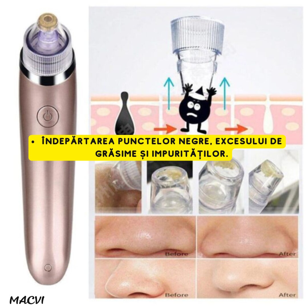 Aparat Vacuum Presure Cleaner Macvi® pentru Curatarea Tenului, Puncte Negre si Grasime